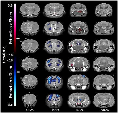 Widespread Volumetric Brain Changes following <mark class="highlighted">Tooth Loss</mark> in Female Mice